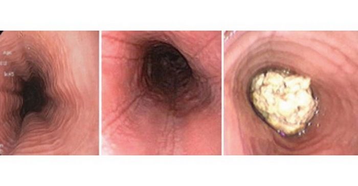 эозинофильный эзофагит.jpeg